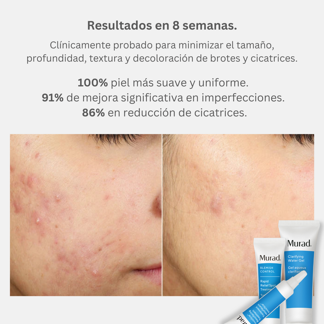 Murad Kit Target Blemish Scars: Elimina Imperfecciones y Cicatrices - Piel Clara y Suave