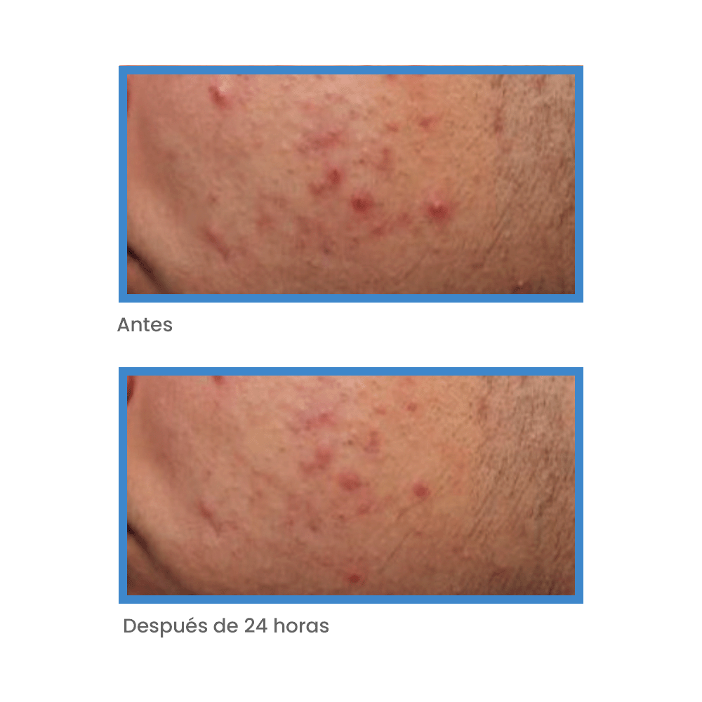 Murad Blemish Control Kit – Oil and Pore Control + Spot Treatment -Anti-Imperfecciones para Piel Grasa