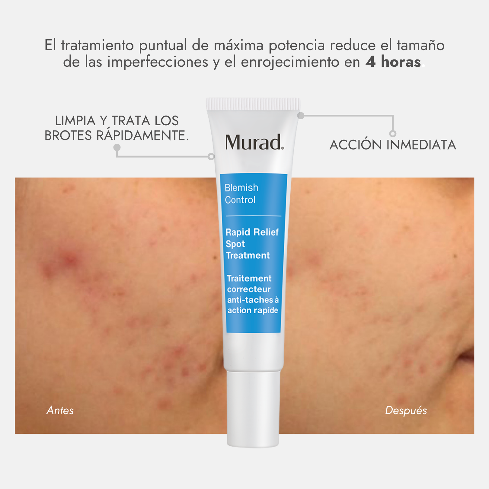 Murad Rapid Relief Spot Treatment 15ml - Tratamiento Antiacné Rápida Acción, Elimina Brotes en Horas - ebeauty