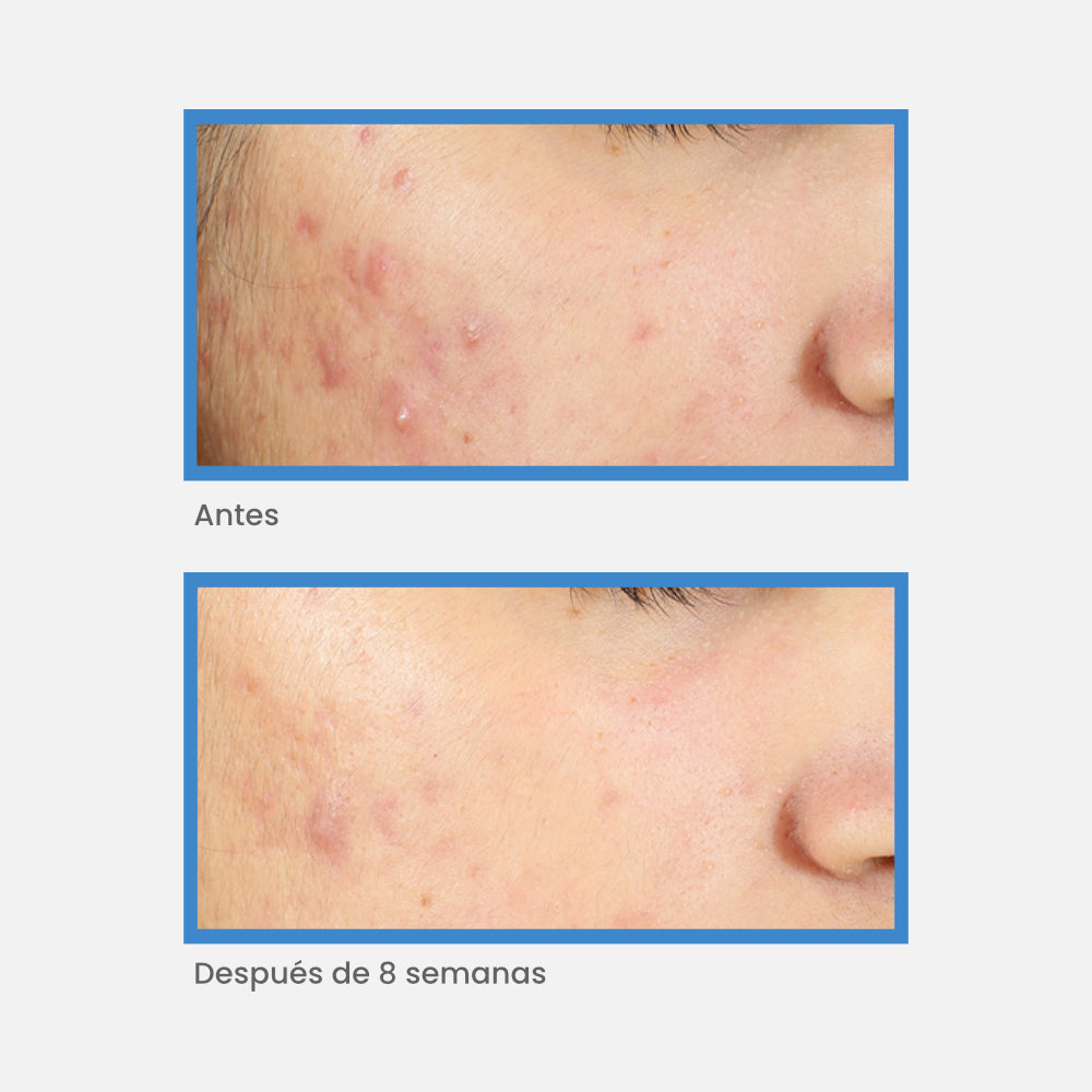 Murad - Acné- Invisiscar Treatment 15 ml - ebeauty