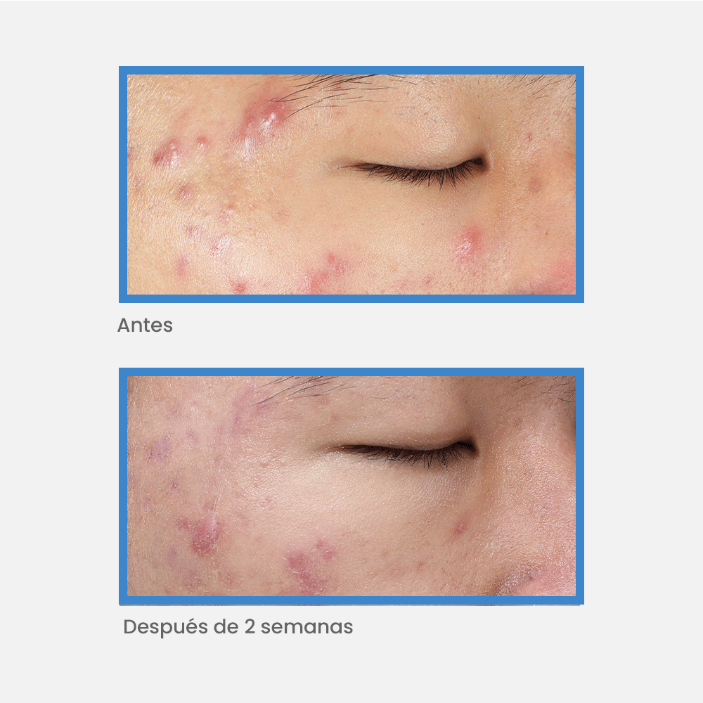 Murad - Acné - Deep Relief Blemish Treatment - 30ml - ebeauty
